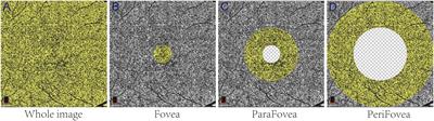 Decreased macular choriocapillaris in thyroid-associated ophthalmopathy: focusing on chorioretinal folds with and without optic disc edema